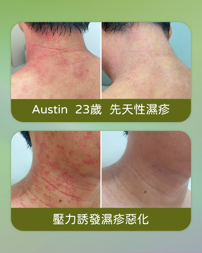 濕疹個案分享 — Austin、壓力誘發濕疹