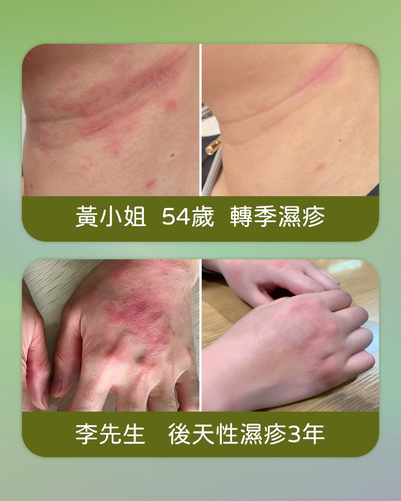 濕疹個案分享 — 黃小姐、李先生